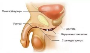 Дискомфорт в головке полового члена