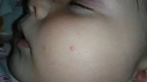 Странные прыщи у ребенка