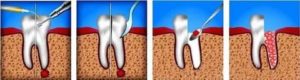 Боли после удаления зуба с кистой