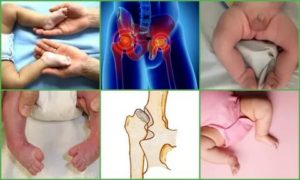 Дисплазия суставов у 3х месячного ребенка