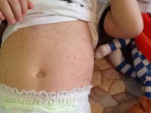 Вечером поднимается температура и у ребенка появляется сыпь
