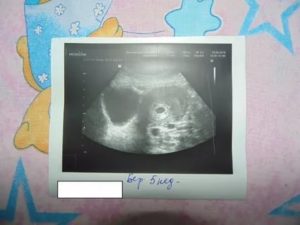 Кровотечение после узи