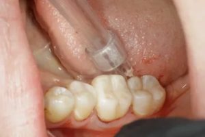 Горечь после лечения зуба