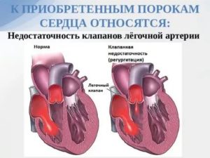 Дисфункция клапана легочной артерии