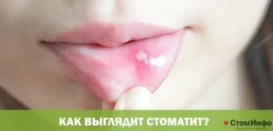 Стоматит на половой губе