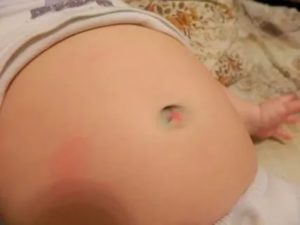 Мокнет пупок у ребенка в 6 месяцев