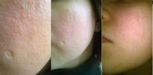 Странная сыпь на щеках и предплечьях ребенка, дерматолог не помог