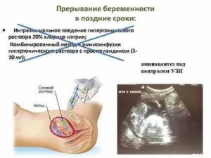 Как сорвать беременность на позднем сроке