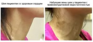 Вздутие вен на голове и пульсация