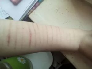 Порезы на руках подростка при медосмотре. Что делать?
