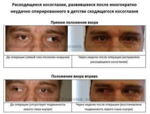 Косоглазие после операции какие можете дать рекомендации