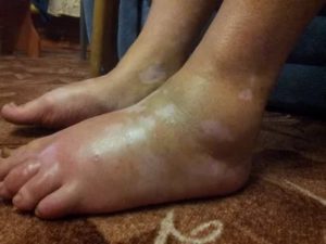 Проблема с пальцами ног. Выделение жидкости и опухание