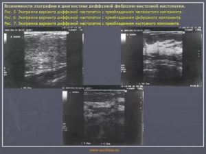 Консультация по результам УЗИ: фиброзно-кистозная мастопатия.