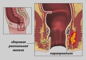 Выделения после парапроктита