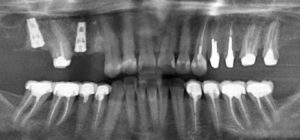 Неполностью запломбирован канал в зубе под коронкой