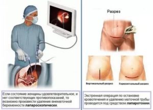 Как избежать повторной внематочной беременности?