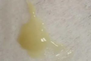 Коричневые выделения, лечение от молочницы