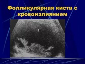 Киста левого яичника с кровоизлиянием в стадии регресса