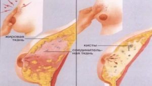 Болит грудь через неделю после месячных