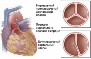 Двухстворчатый клапан аорты