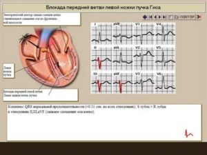Блокада передней ветви левой ножки п. Гиса у ребенка