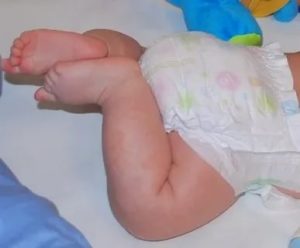 Появилось пятнышко на ножке у новорожденной
