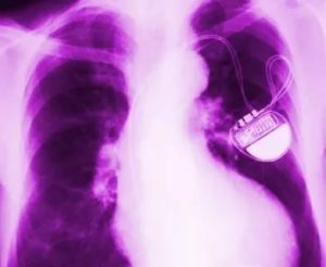Можно ли делать рентген ладони, если установлен кардиостимулятор?