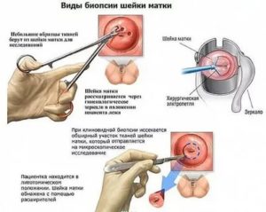 Лейкоплакия шейки матки и эктопия. Результаты биопсии