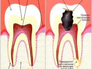 Боль в переднем зубе при периодонтите