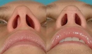 Костный шип носовой перегородки