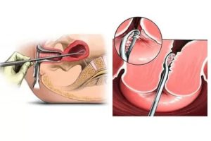 Кровотечение или месячные после чистки и удаления полипа