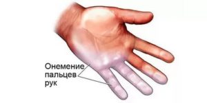 Немеет левая рука