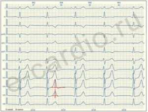 Высокий зубец Т на ЭКГ