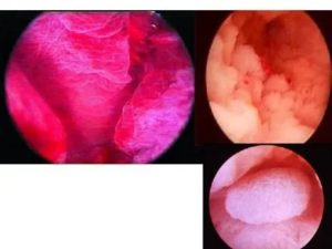 Лечение после выскабливания: железисто-фиброзный полип эндометрия