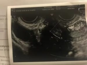 Фолликул 17 мм