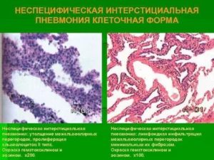 Консультация по неспецифическая интерстициальная пневмония