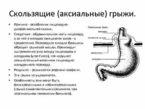 Фитнес и скользящая грыжа в пищеводе