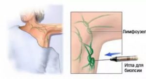 Биопсия лимфоузла