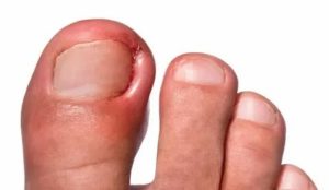 Воспаление большого пальца ноги