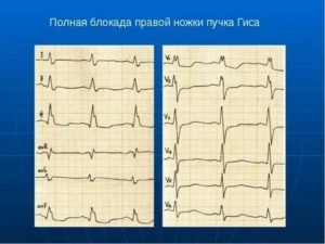 Блокада правой ножки пучка Гиса