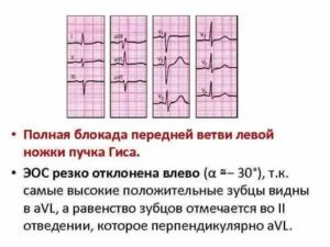 Блокада передней ветви левой ножки п. Гиса у ребенка