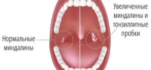 Увеличена миндалина, температуры нет