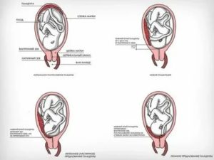 Выделения при беременности при низком плацентации!