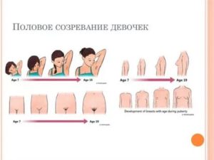 Половое созревание девочек