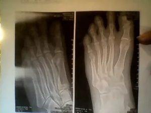 Не сросшийся перелом 5 плюсневой кости
