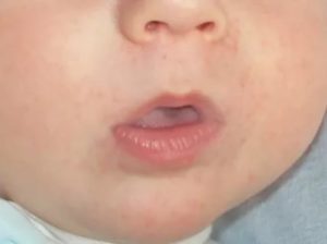 Появилась аллергия при прорезывании зубов