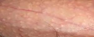 Бледно розовые пупырышки на стволе члена и лобковой области (фото)