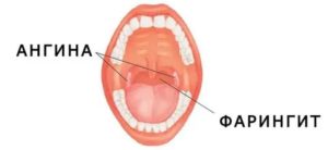 Сухость в горле и покраснение задней стенки глотки