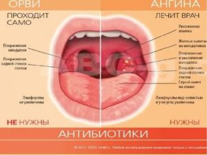 Возможно ли появление ОРВИ после ангины?