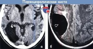 Порэнцефалическая киста головного мозга 4,4x3,9 см